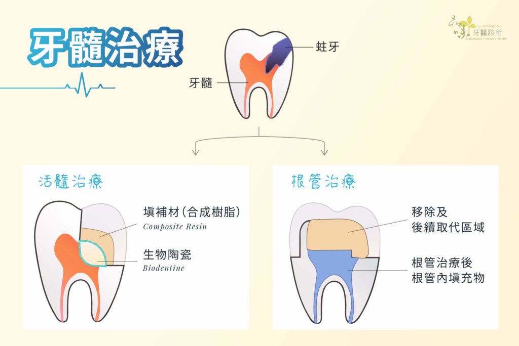 活髓治療與根管治療填充物的差異