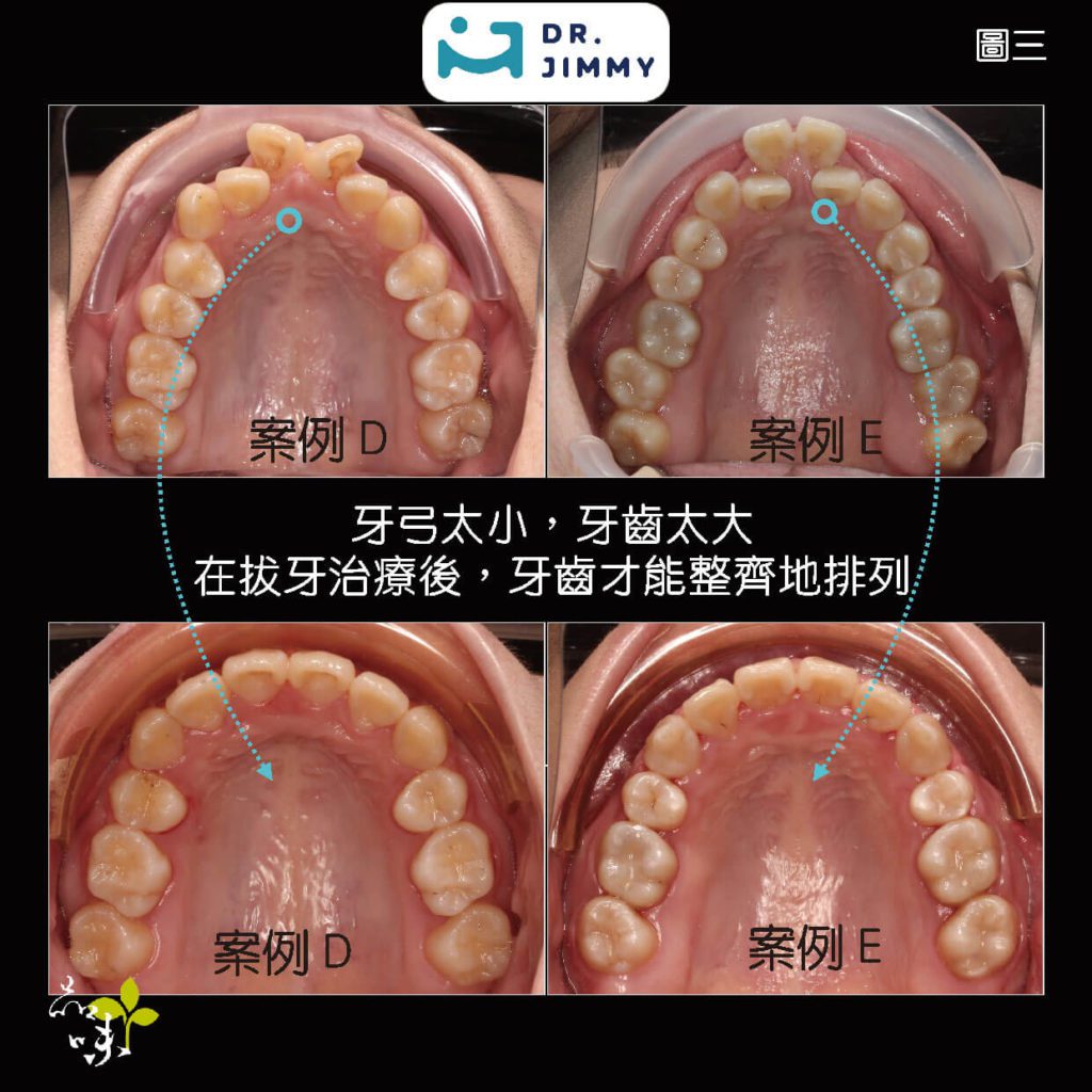 蔡騏駿矯正案例窄牙弓