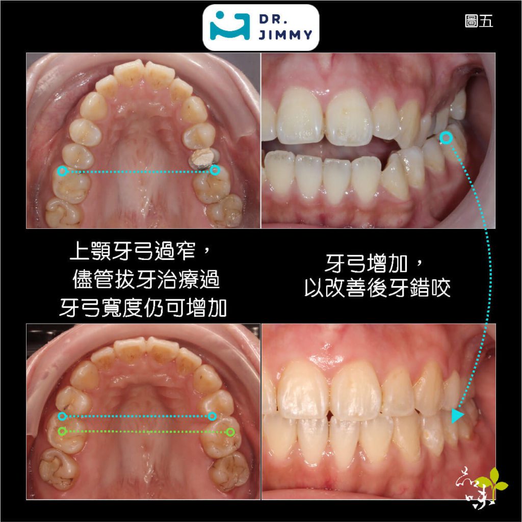 蔡騏駿矯正案例後牙錯咬