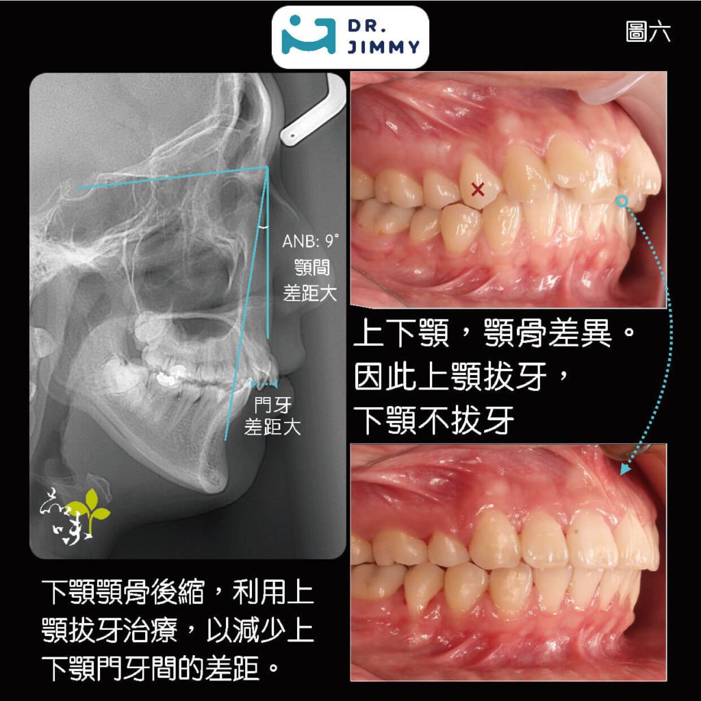 減少上下顎門牙差距X光
