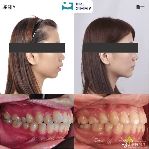 蔡騏駿矯正案例一側面