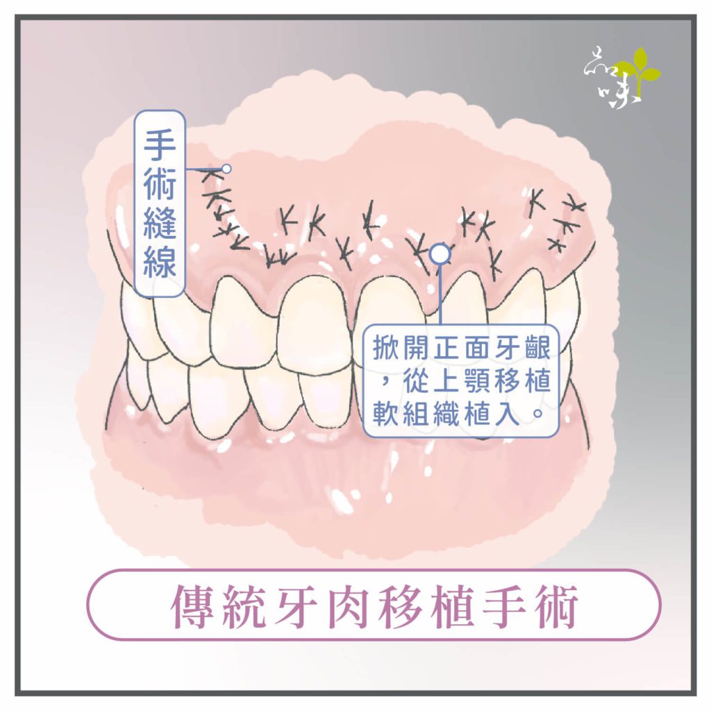 掀開牙齦植入上顎移植軟組織的縫線