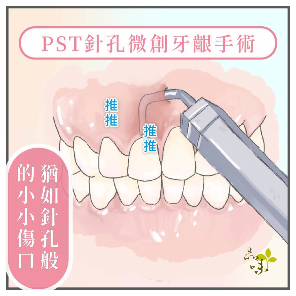 品味牙醫針孔微創牙齦再生手術