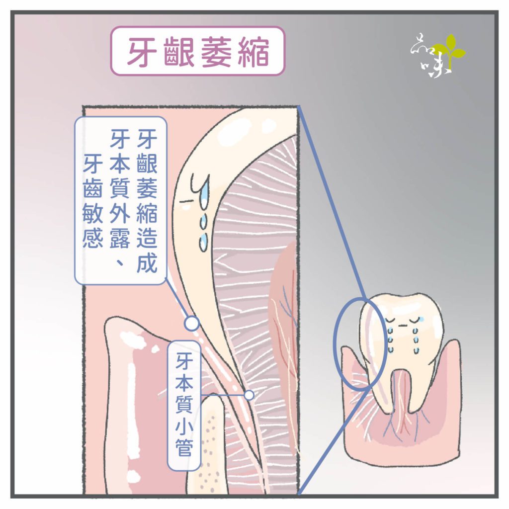 牙齦萎縮造成牙本質外露