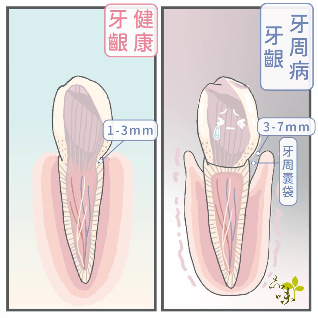 牙周病牙齦的牙周囊袋深度3-7mm