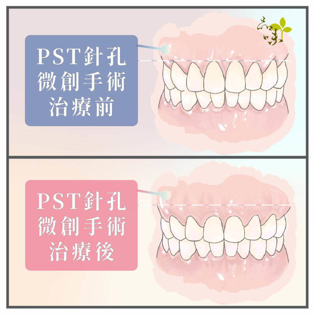 針孔微創牙齦修補手術術前術後對比