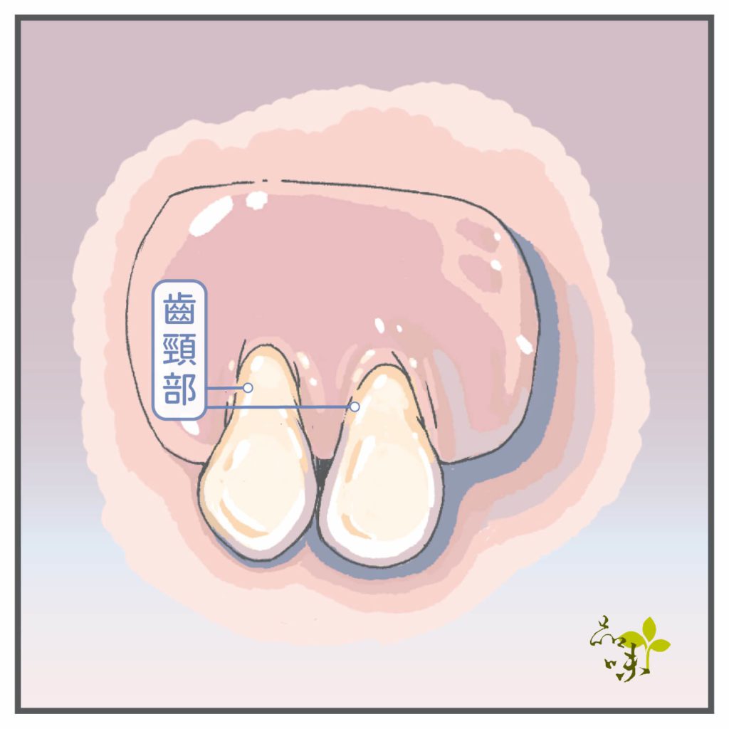 牙齦萎縮齒頸部露出插圖