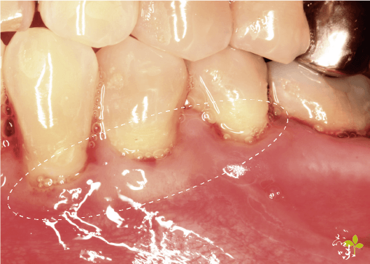 下顎三處牙齦再生手術術後案例照片