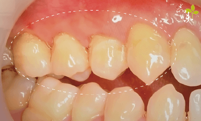 品味牙醫針孔微創牙齦再生手術