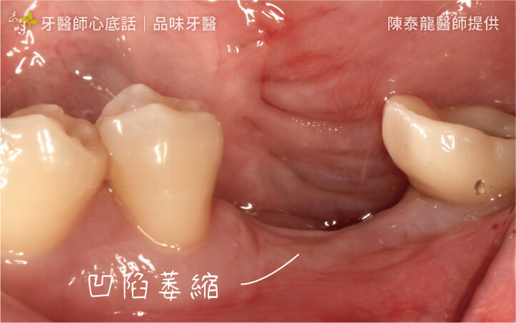 案例三補骨、補肉前：齒槽骨和牙齦量不足。
