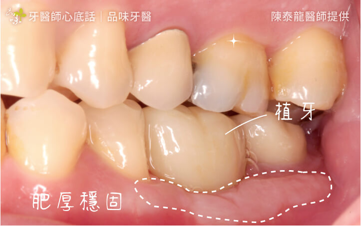 案例三補骨、補肉後：穩固植牙。