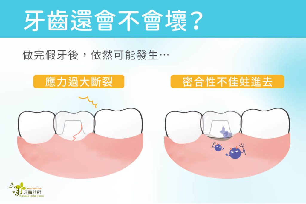 根管治療後裝戴假牙,牙齒仍可能因應力過大斷裂,或密合性不佳蛀進去