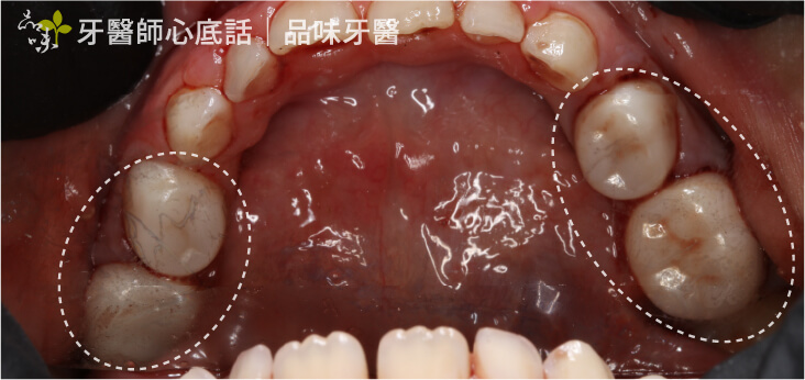 兒童全鋯冠四顆手術後