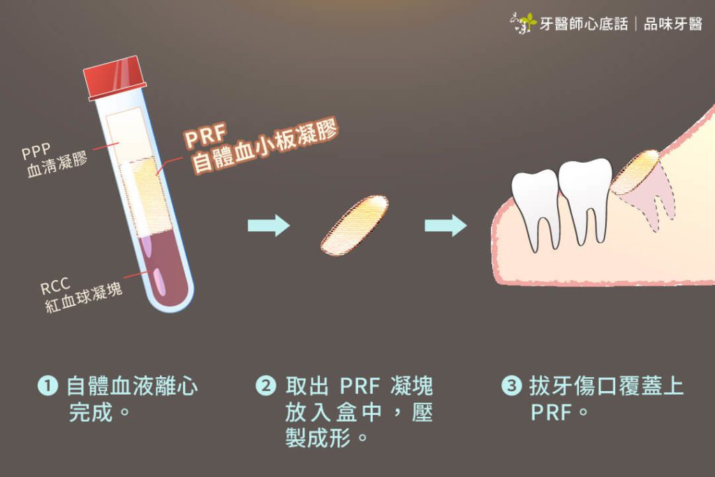 PRF自體血小板凝膠再生膜傷口運用