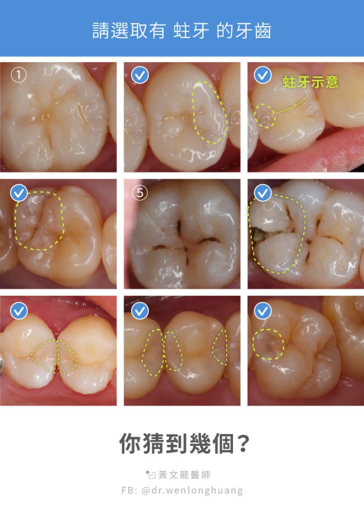 牙齒蛀牙猜謎九宮格解答有六個牙齒蛀牙