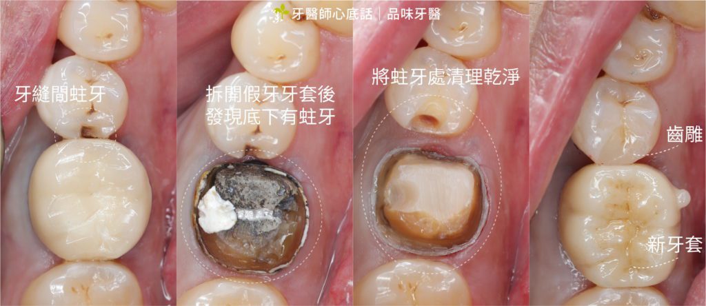 齒縫間蛀牙挖掉做齒雕