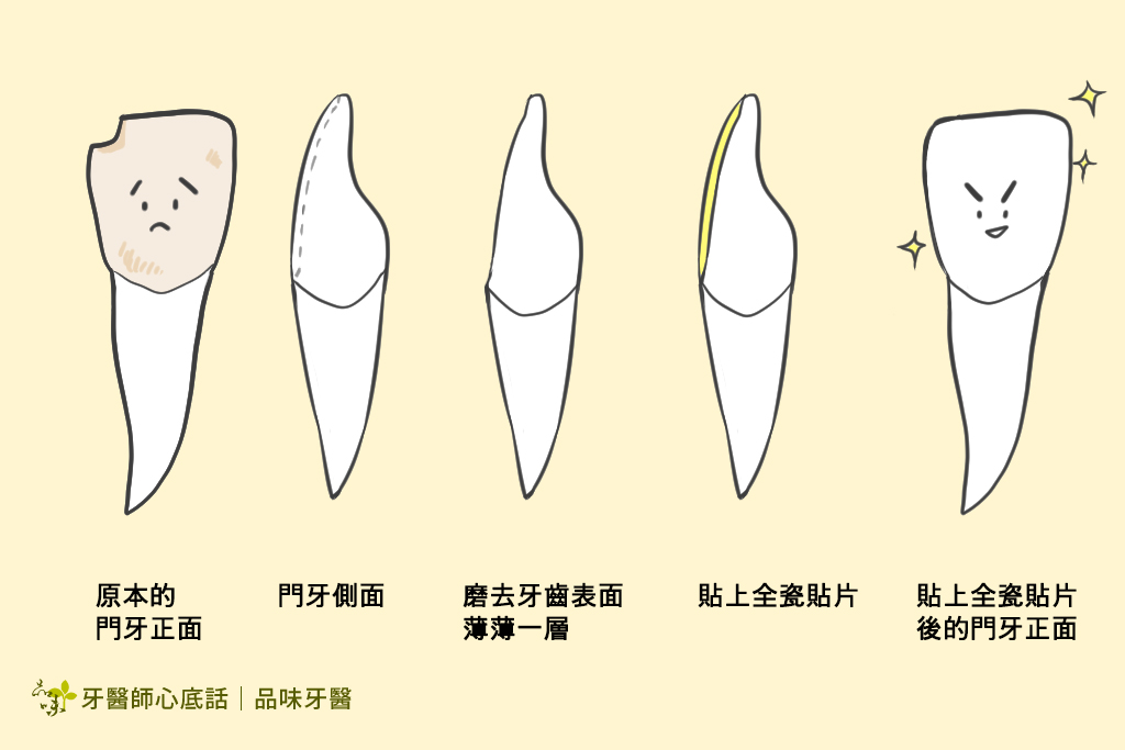 美白貼片流程