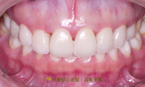 case1郭彥君醫師的美白貼片臨時假牙照片