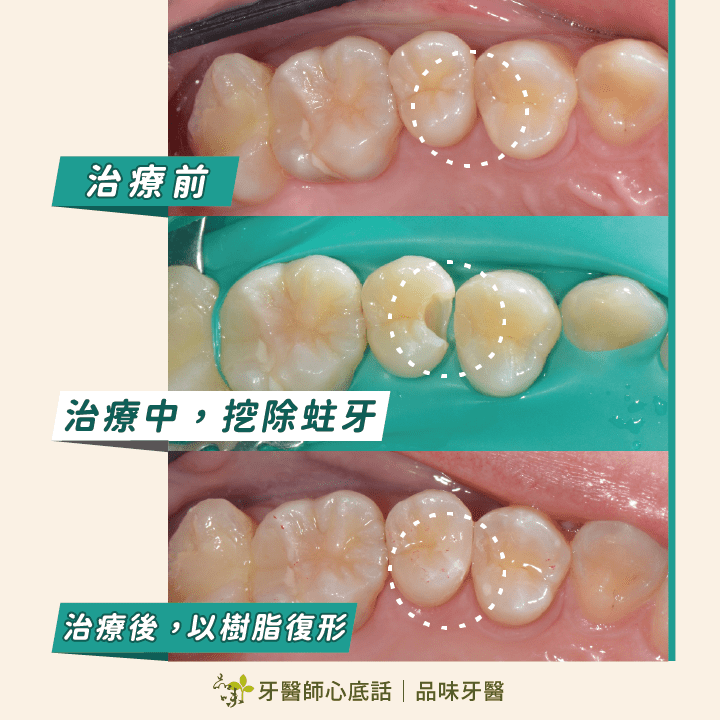 蛀牙治療與裝上3D齒雕的案例照片