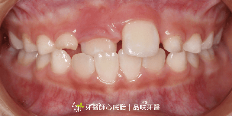 兒童前牙錯咬 上排門牙一顆咬在下排牙齒裡