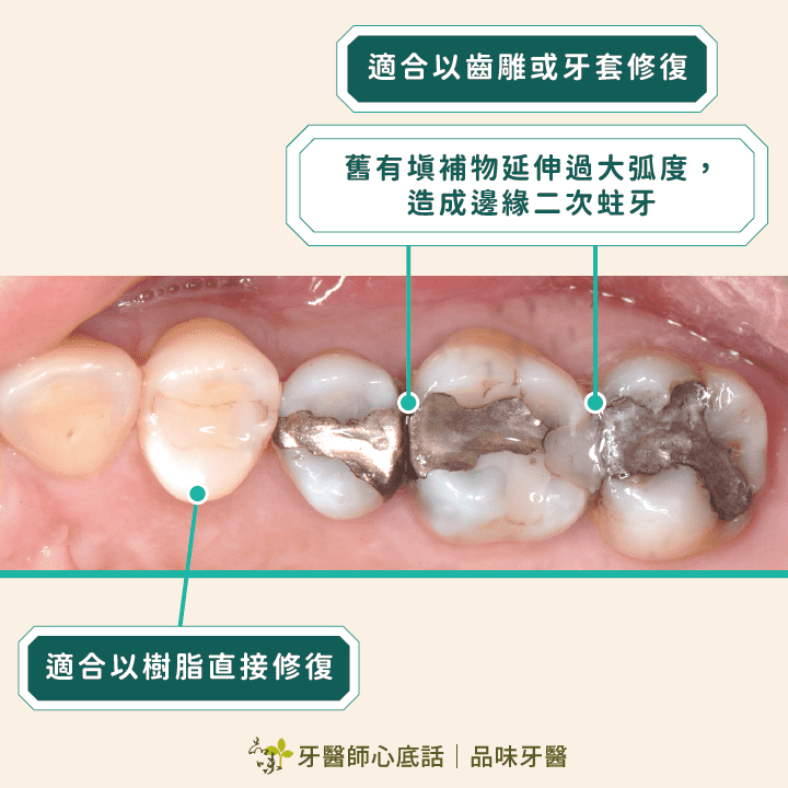 可以用樹脂填補的蛀牙與需要齒雕保護的蛀牙