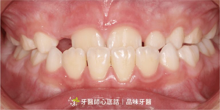 兒童咬合不正 下排門牙咬到上排門牙