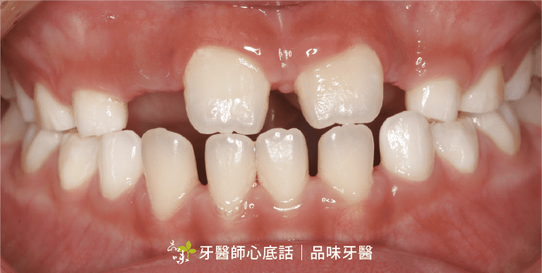兒童前牙開咬 門牙兩邊咬不到