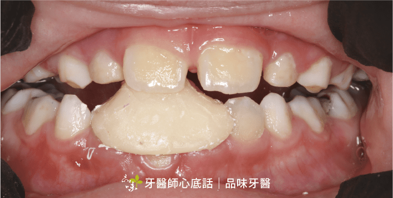 斜咬板 咬合斜板治療咬合不正