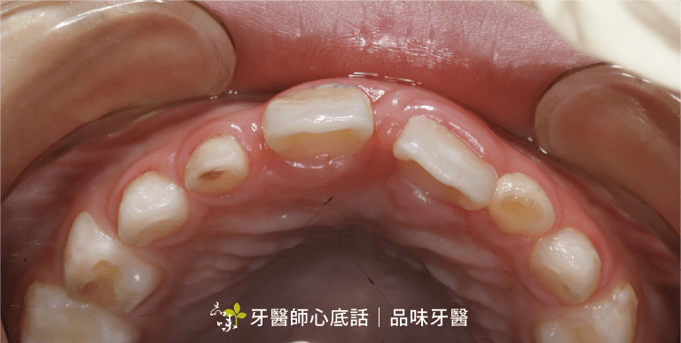 七歲兒童門牙不正斜咬板治療後上顎照片