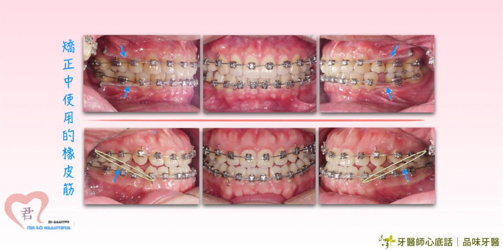 自鎖式牙齒矯正綁橡皮筋