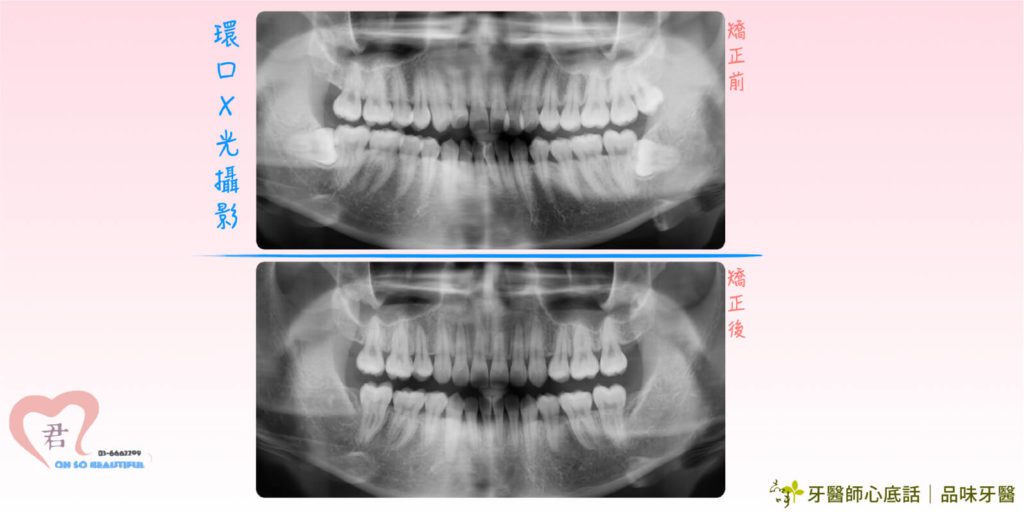 牙齒矯正環口Ｘ光片