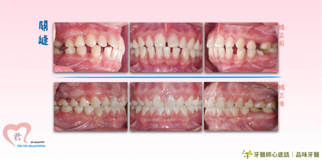 牙縫大關起來的牙齒矯正