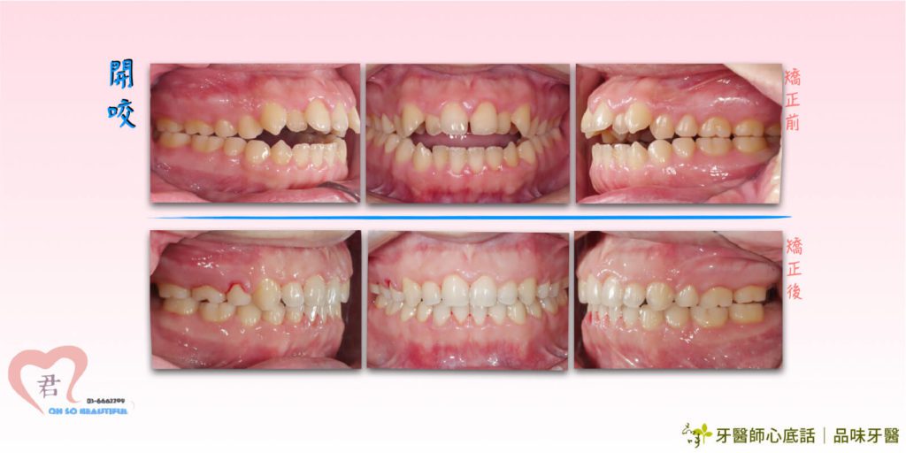 新竹開咬牙齒矯正術前術後