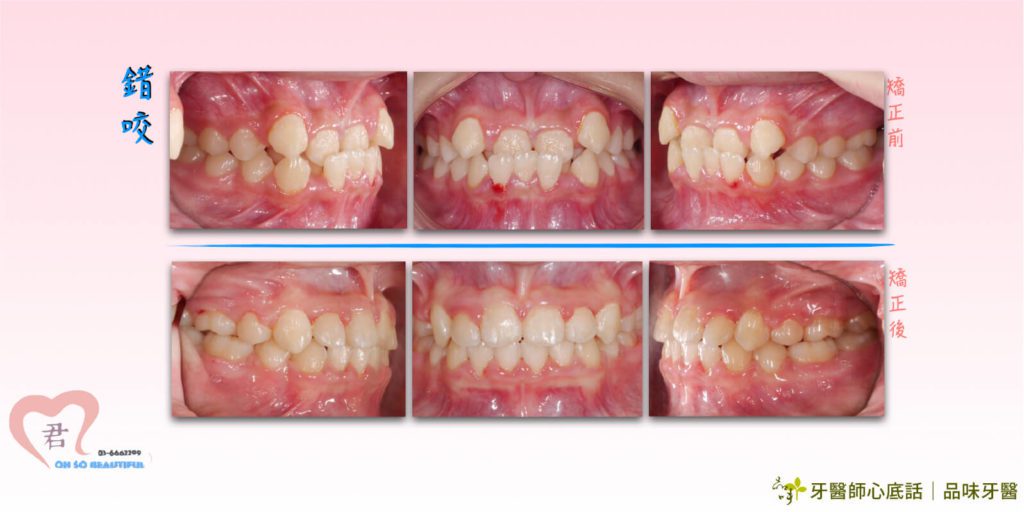 錯咬牙齒矯正術前術後