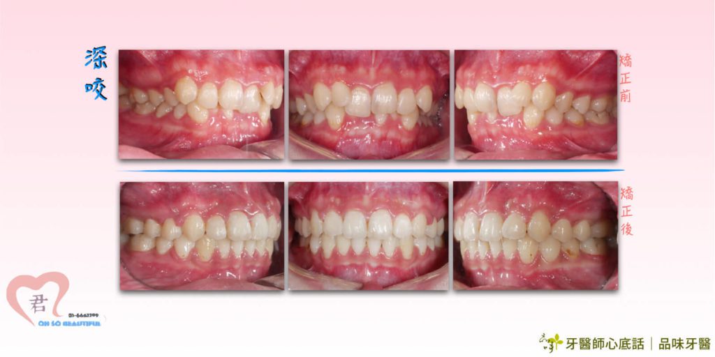 深咬牙齒矯正術前術後