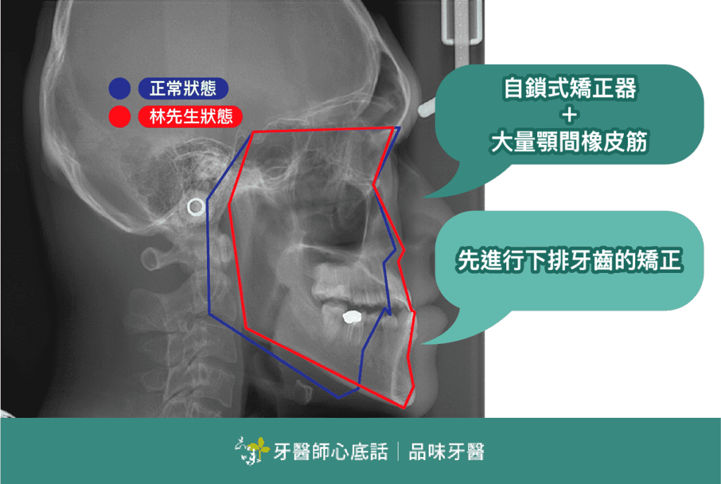 品味牙醫蔡騏駿醫師戽斗矯正案例