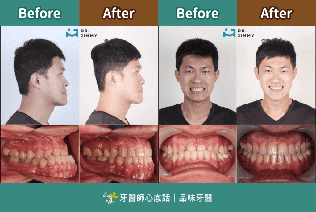 品味牙醫蔡騏駿醫師戽斗矯正案例