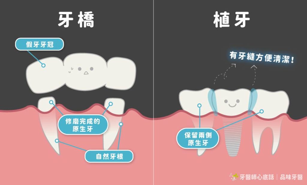 牙橋 vs 植牙
品味牙醫