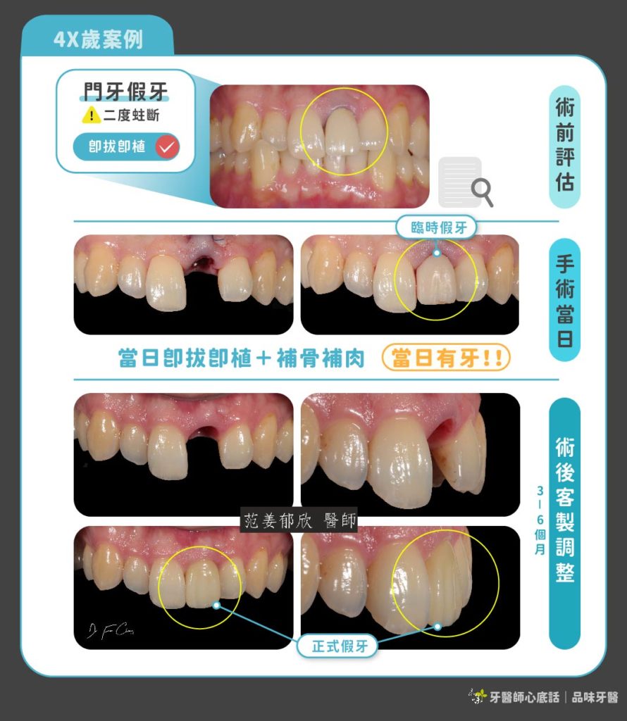 門牙植牙一日完成案例
案例提供：品味牙醫 范姜郁欣醫師