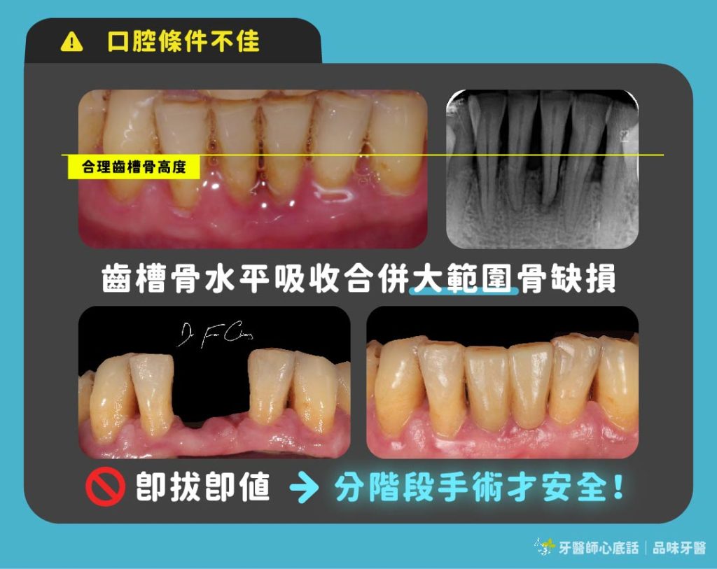 口腔狀況不佳的患者，醫師會分階段手術保障患者安全。
案例提供：品味牙醫 范姜郁欣醫師