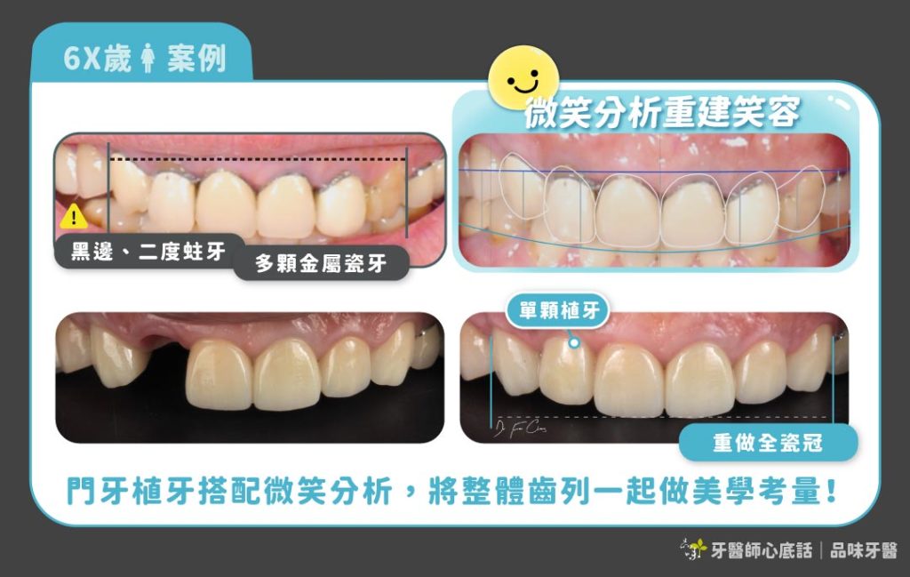 門牙植牙需要多面向考慮才能創造美麗笑容
案例提供：品味牙醫 范姜郁欣醫師
