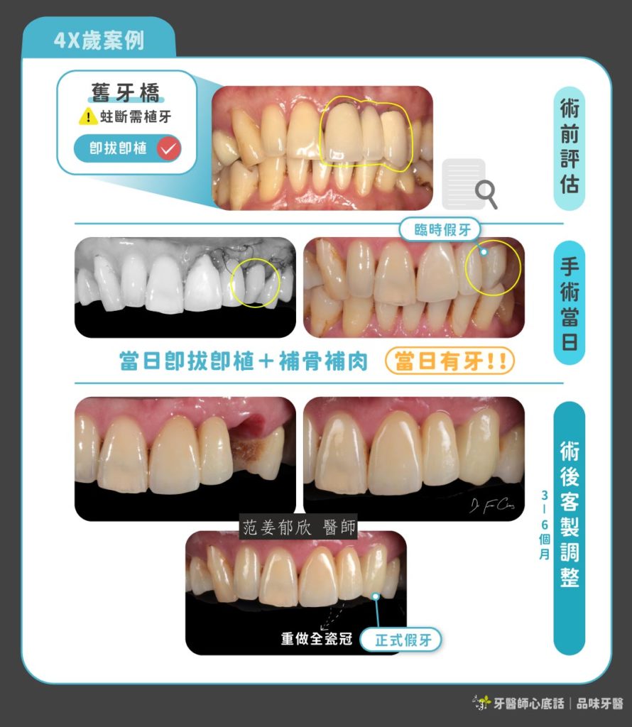 門牙植牙一日完成案例
案例提供：品味牙醫 范姜郁欣醫師