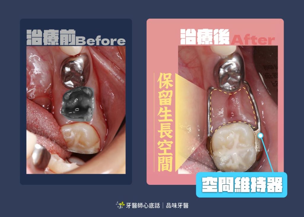 空間維持器治療案例
案例提供：林記賢醫師 品味牙醫