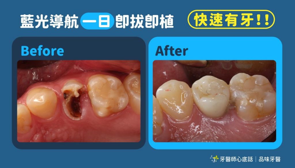 X-GUIDE藍光導航植牙案例，位置精準可以即拔即植，讓你當日有牙。