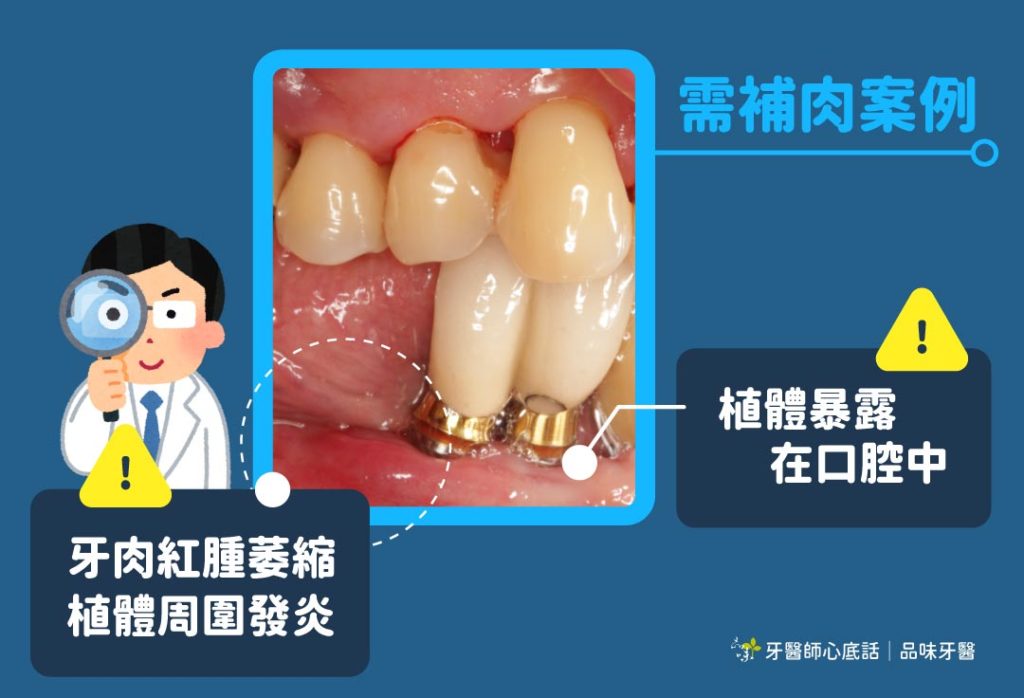 植牙周圍需要有足夠的牙肉厚度，才不會讓植體容易受細菌感染，可以讓植牙壽命延長。