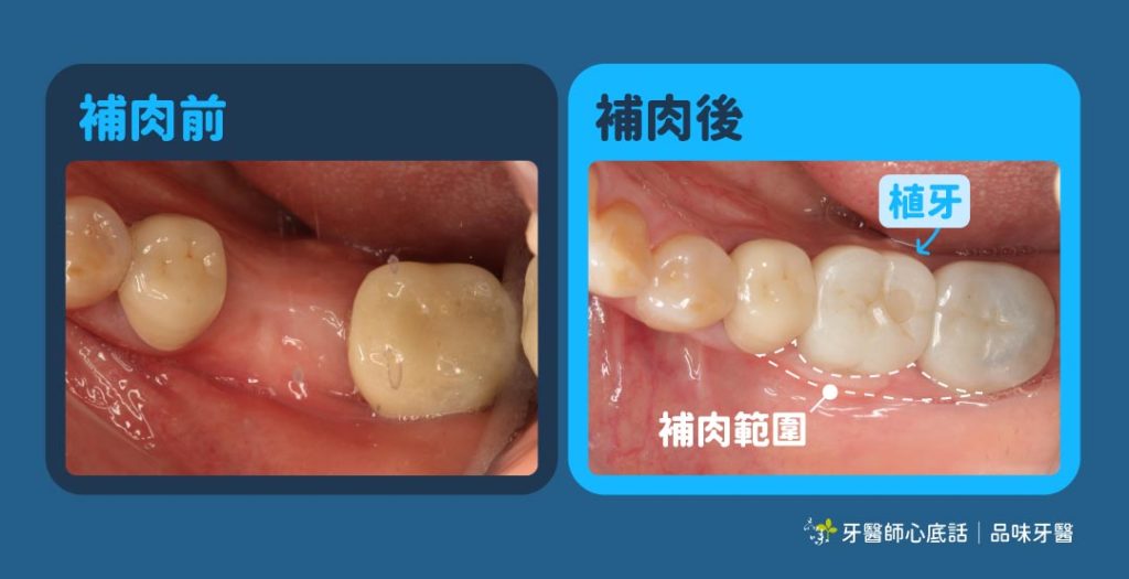 品味牙醫陳泰龍醫師植牙補肉案例