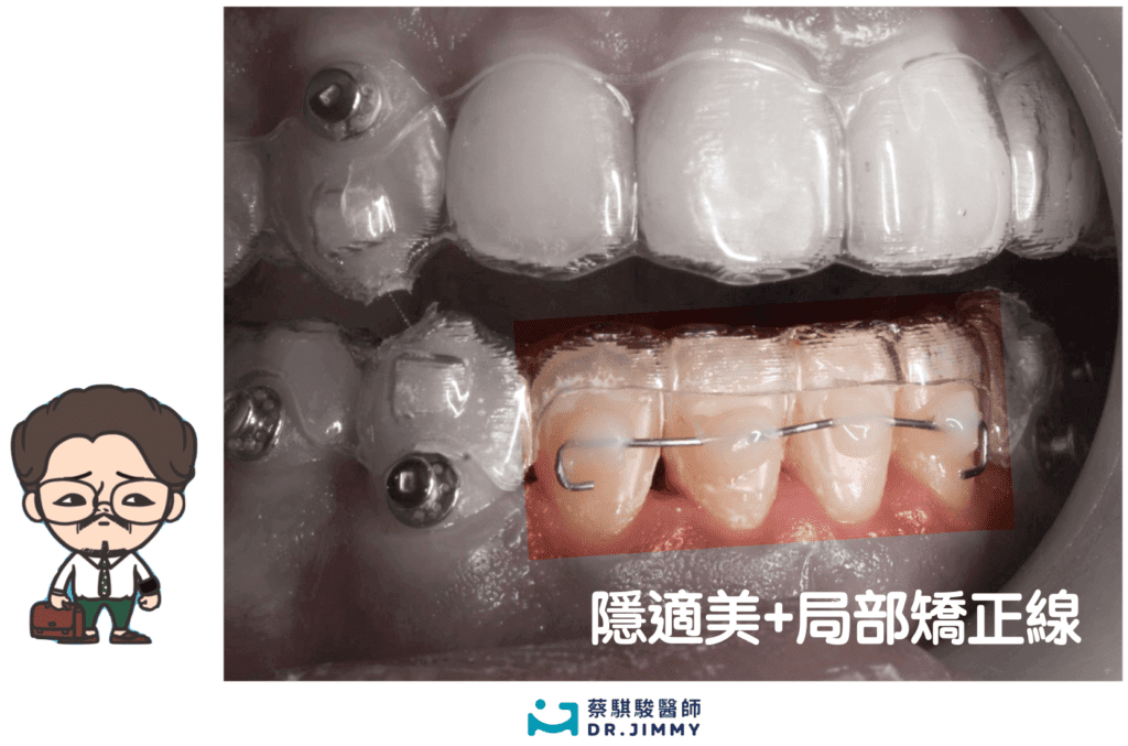 隱適美+局部矯正線