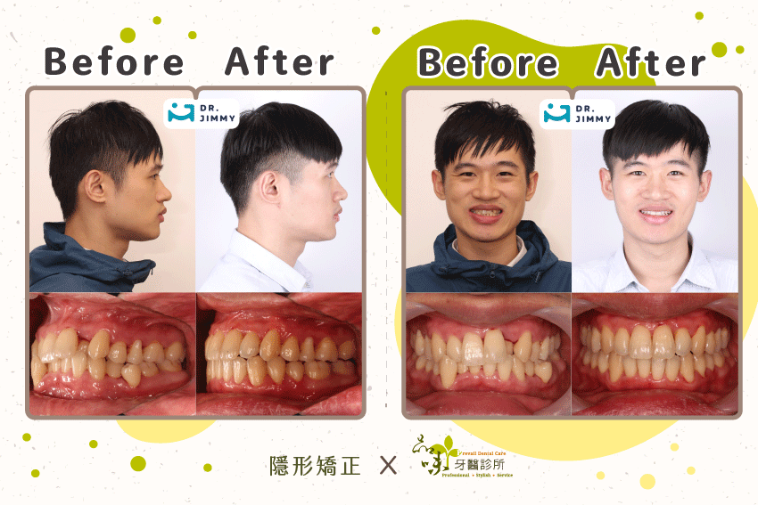 越複雜的案例越需要經驗豐富的專業醫師治療
案例提供:品味診所 蔡騏駿醫師