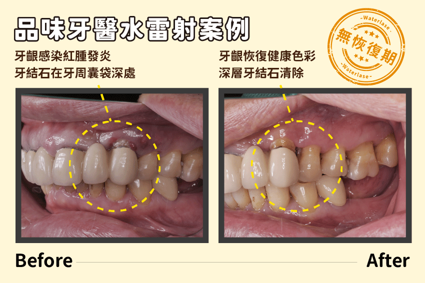 患者使用水雷射治療牙周困擾,不開刀接近洗牙流程就可以清除深層牙結石。
案例提供:郭彥君醫師 品味牙醫