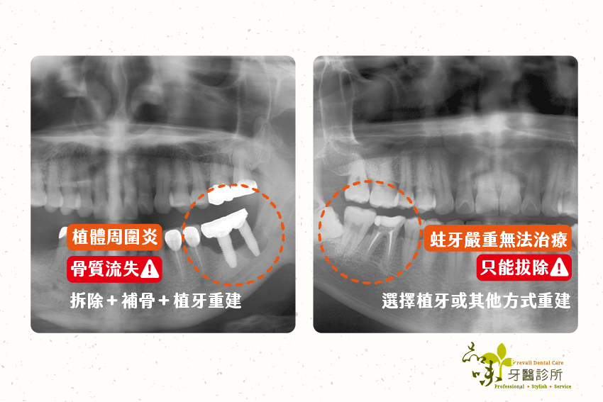 植牙後悔原因：植體相關疾病。圖左為植體周圍炎，造成骨質流失，需要拆除＋補骨＋植牙重建。圖右為蛀牙嚴重無法治療，只能拔牙選擇植牙或其他重建方式。